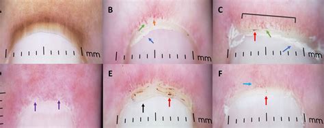 Characterizing Nailfold Capillary Changes In Dermatomyositis With A Dermatoscope Acr Meeting