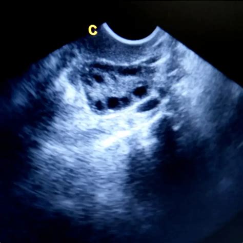 What Do Cysts Look Like On Ultrasound