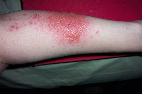 Is Poison Ivy Contagious