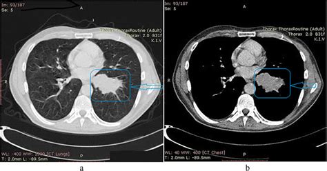 Skin Metastases From Lung Cancer A Case Report Bmc Research Notes