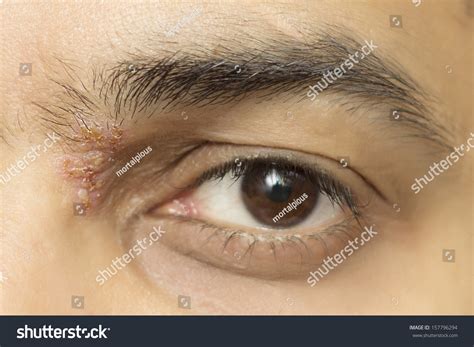 Herpes Zoster Ophthalmicus Eye Herpetic Cold Stock Photo 157796294