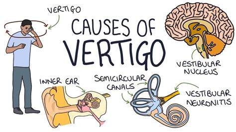 What Is Vestibular Vertigo Tiswha