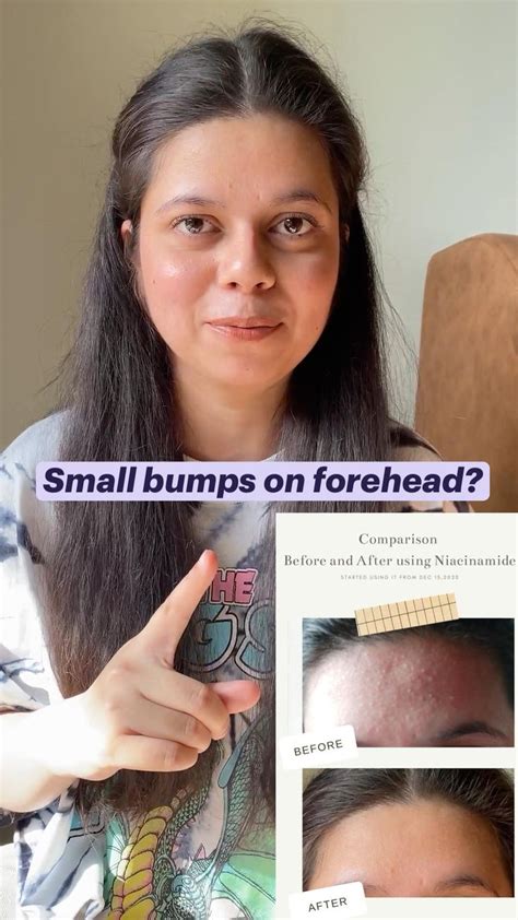 How To Get Rid Of Small Bumps On Forehead Before And After