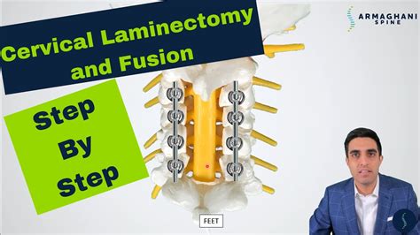 Posterior Cervical Laminectomy And Fusion Procedure Details Recovery