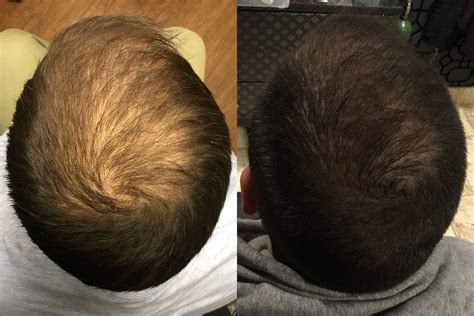 Hair Rejuvenation Prf Microneedling Before And After 04 Bella Vi