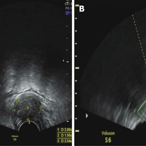 Transvaginal Ultrasound Images A The Thickness Of Cervix Was About