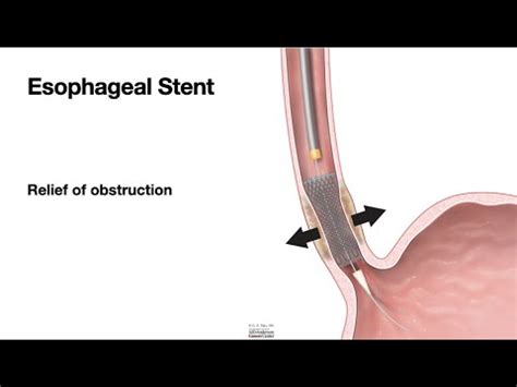 HCC 1475 40 Esophageal Stent YouTube