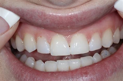 How To Fix A Cavity In The Front Teeth Teethwalls