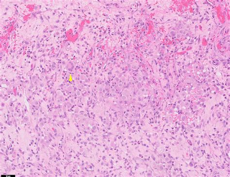 Pathology Outlines Mesothelioma Epithelioid