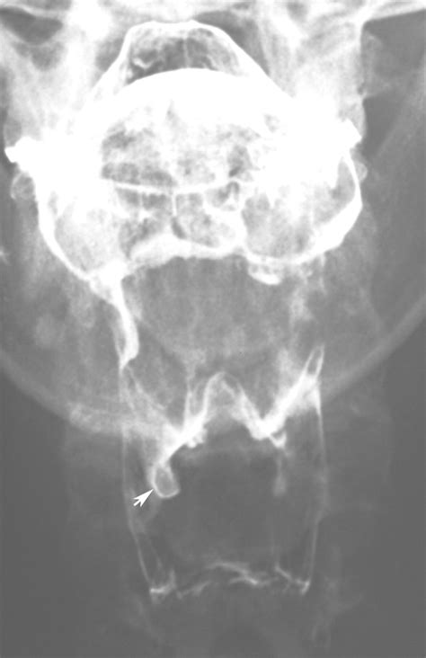 Pharyngeal Retention Cysts Radiographic Findings In Seven Patients Ajr