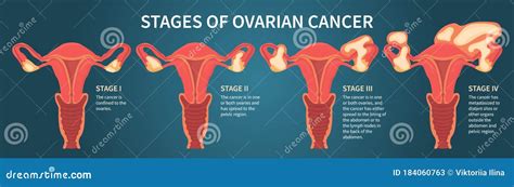 Ovarian Cancer Stages Chart My Xxx Hot Girl