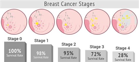 What Is The Survival Rate Of Metastatic Breast Cancer Updated