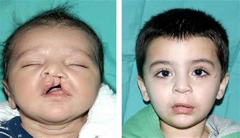 Cleft Lip And Cleft Palate Causes And Treatment