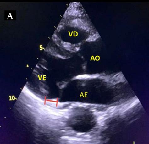 Mitral Annulus Disjunction Diagnostic Modalities Clinical