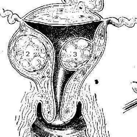 Subserosal fibroids are located just under the outer layer of the uterus. Fibroid Cysts in the Uterine Walls | Fibroid cyst ...