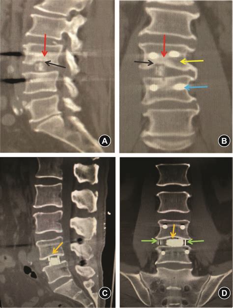 Computed Tomography Ct Images After Oblique Lumbar Interbody Fusion