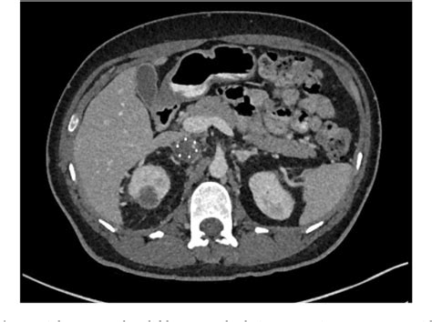 Figure 1 From A Diagnostic And Management Conundrum In A Rare Case Of A