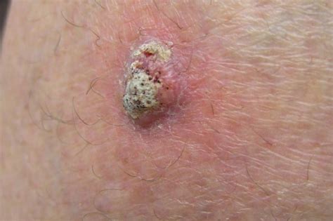 Squamous Cell Carcinoma Definition Of Squamous Cell Carcinoma