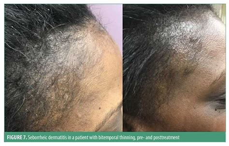 Seborrheic Dermatitis Hair Loss Permanent Had A Fat Podcast Photography