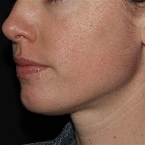 Rosacea Redness Birth Marks Port Wine Stains Dermatology Of The