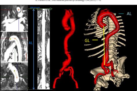 Figure From Increased Aortic Tortuosity Indicates A More Severe Aortic Phenotype In Adults