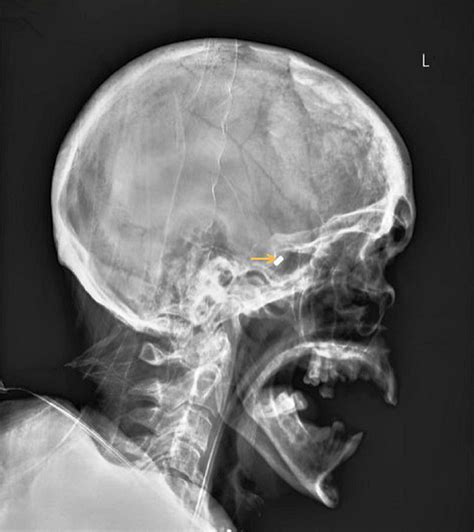 Cureus Nasal Bridles For Securing Nasoenteric Feeding Tubes A Review