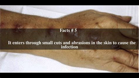 Sporotrichosis Top 8 Facts Youtube
