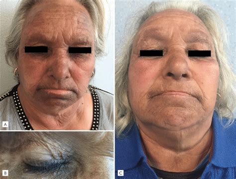 Slate Gray Hyperpigmentation On The Face A Sparing The Cutaneous