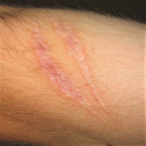 About Scars Burn Survivor