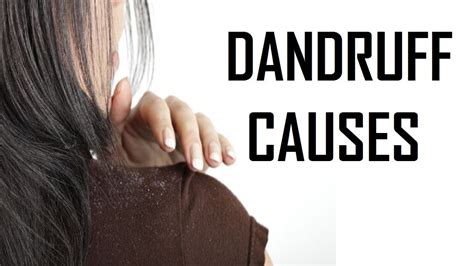 11 Big Causes Of Dandruff Youtube