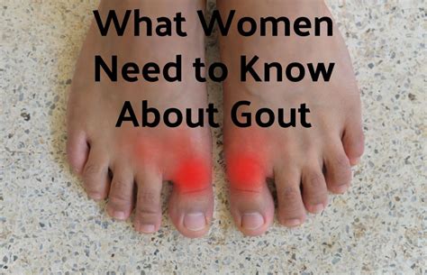 What Women Need To Know About Gout Rocky Mountain Foot And Ankle