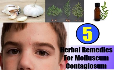 5 Best Herbal Remedies For Molluscum Contagiosum Natural Home
