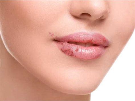 Find Out What The Appearance Of White Spots On Your Lips Indicates