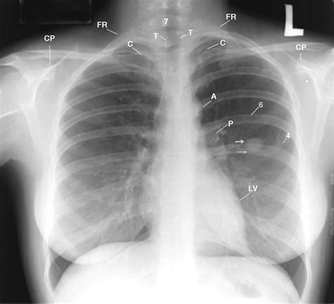 Chest Radiograph Cost Effectively Detects Benign Pulmonary Lesion