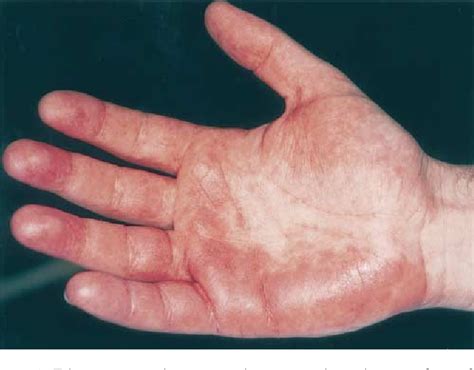 Figure 1 From Chemotherapy Induced Acral Erythema Semantic Scholar