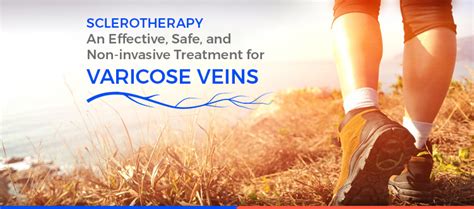 Sclerotherapy An Effective Safe And Non Invasive Treatment For