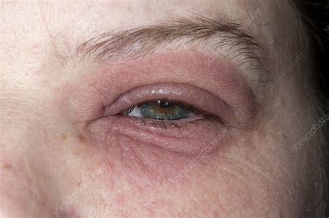 Eczema Around The Eye Stock Image C0111670 Science Photo Library