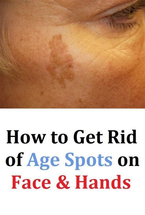 How To Get Rid Of Age Spots On Face And Hands Age Spots On Face Spots On Face Face Skin Care