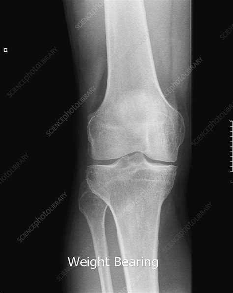 Osteoarthritis In The Knee X Ray Stock Image C0168215 Science