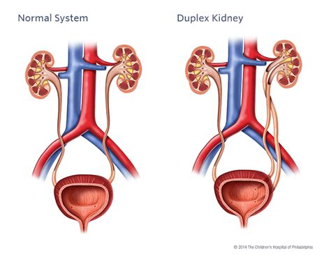 Duplex Kidney Childrens Hospital Of Philadelphia