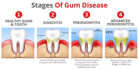 Periodontitis Its Causes Warning Signs And How To Prevent It Dr Vlahos Family Dentistry