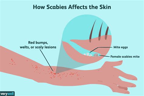 Scabies Overview And More
