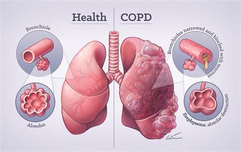Health Copd Lung Disease Pelajaran