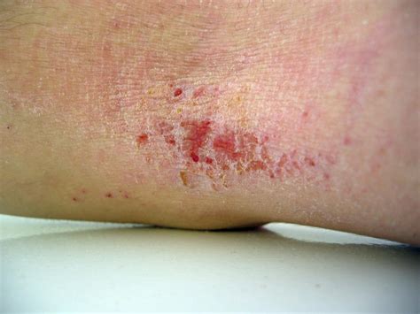 Diferenças Entre Eczema E Psoríase Ptmedbook