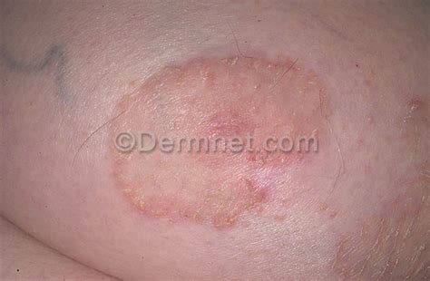 Eczema Pictures In Adults Dorothee Padraig South West Skin Health Care
