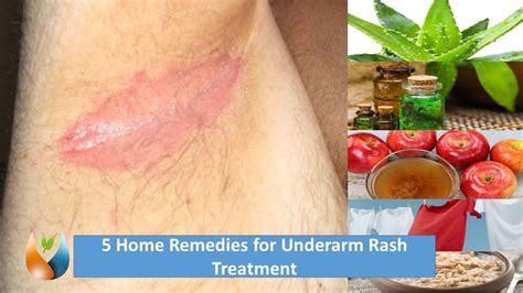 It's been 10 months since i started out on this journey and i'm not to see a full recap of all the the best natural deodorants i tried watch the video i filmed. 5 Home Remedies for Underarm Rash Treatment - YouTube