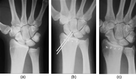 A Posteroanterior Wrist Radiograph Revealing Ulnar Translocation Of