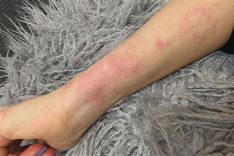Lupus Rash On Legs Images