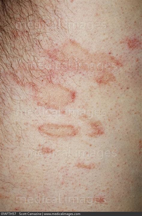 Stock Image Close Up Of Eczema Showing An Eczematous Skin Rash On The