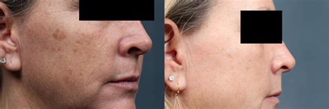 Pico Genesis Laser Treatment Before And After Photos Patient 700
